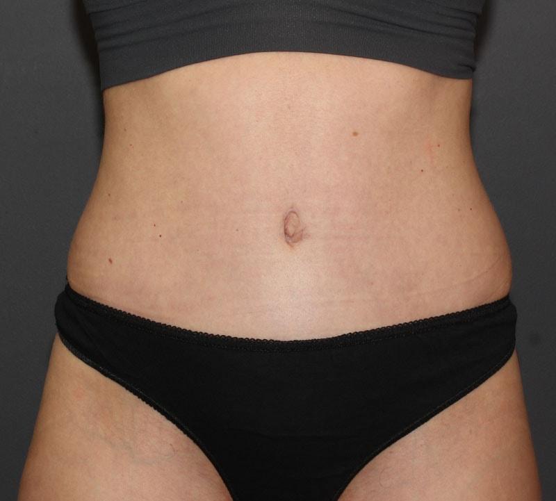 SVIA Plastic Surgery San Mateo tummy tuck after — San Mateo, CA
