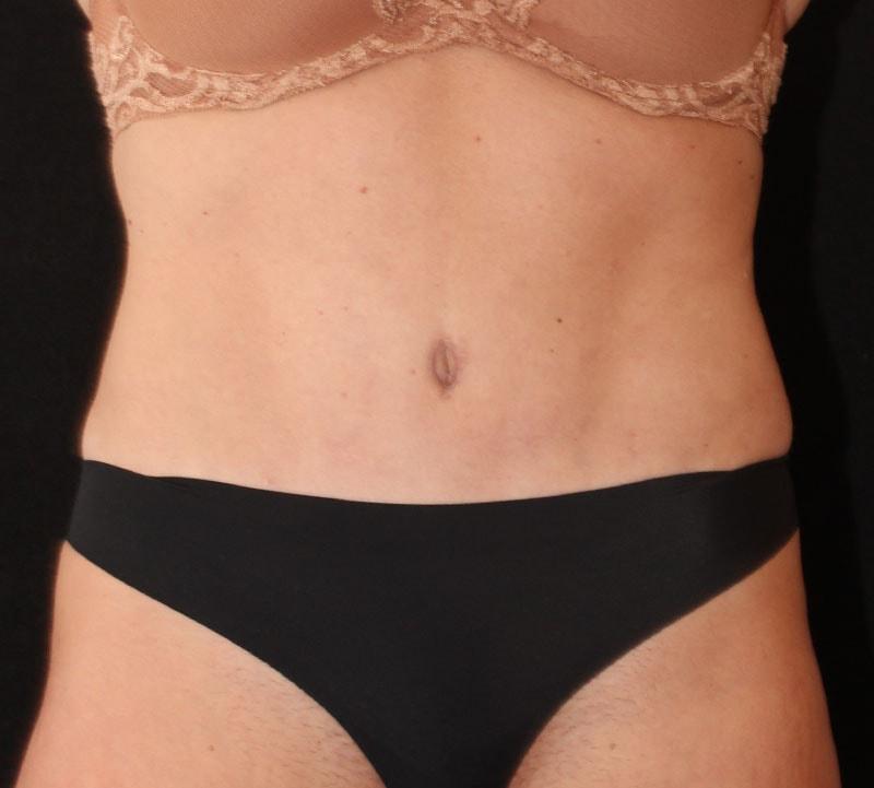 SVIA Plastic Surgery San Mateo tummy tuck after — San Mateo, CA