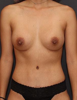 SVIA Plastic Surgery San Mateo mommy makeover after — San Mateo, CA
