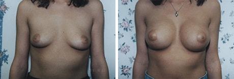 Breast Augmentation result at Bohley Plastic Surgery Center in Portland, OR