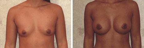 Bohley Plastic Surgery Center breast augmentation result — Portland, OR