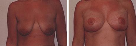 Bohley Plastic Surgery Center breast lift result — Portland, OR