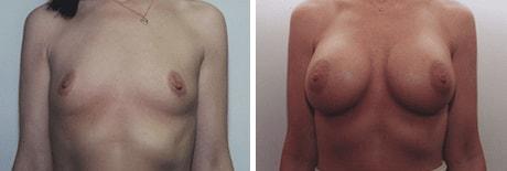 Bohley Plastic Surgery Center breast augmentation result — Portland, OR