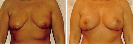Bohley Plastic Surgery Center breast lift result — Portland, OR