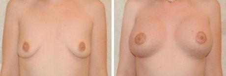 Bohley Plastic Surgery Center breast lift result — Portland, OR