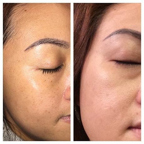 Bohley Plastic Surgery Center photofacial result — Portland, OR