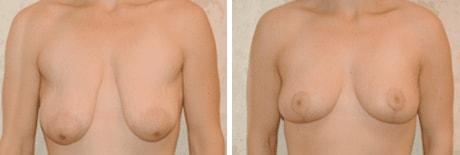 Bohley Plastic Surgery Center breast lift result — Portland, OR