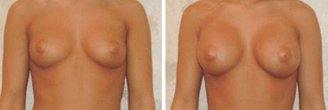 Bohley Plastic Surgery Center breast lift result — Portland, OR