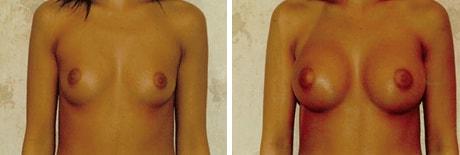Bohley Plastic Surgery Center breast augmentation result — Portland, OR