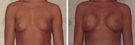 Bohley Plastic Surgery Center breast augmentation result — Portland, OR