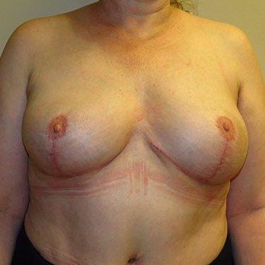 Philip J. Straka, MD, FACS breast implant removal after — Rosemont, IL