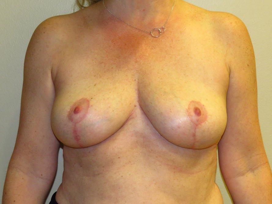 Philip J. Straka, MD, FACS breast implant removal after — Rosemont, IL