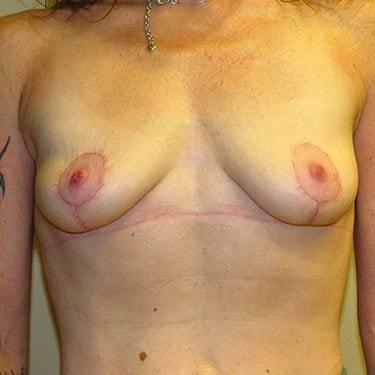 Philip J. Straka, MD, FACS breast implant removal after — Rosemont, IL