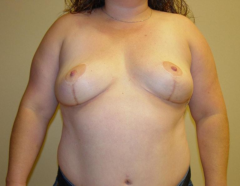 Philip J. Straka, MD, FACS breast implant removal after — Rosemont, IL