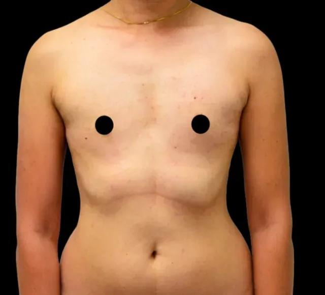 Liposuction before at Dr. Nima Plastic Surgery in Los Angeles, CA