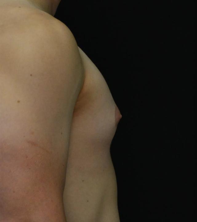Gynecomastia Surgery before at Dr. Nima Plastic Surgery in Los Angeles, CA