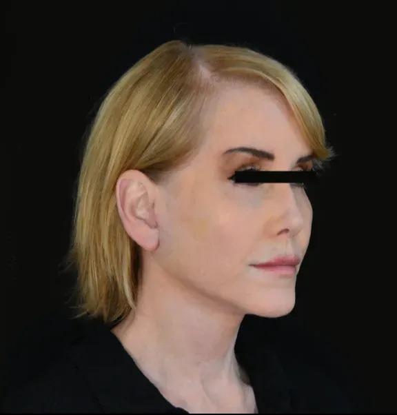 Dr. Nima Plastic Surgery facelift after — Los Angeles, CA