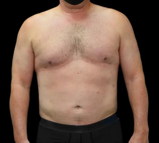 Liposuction after at Dr. Nima Plastic Surgery in Pasadena, CA
