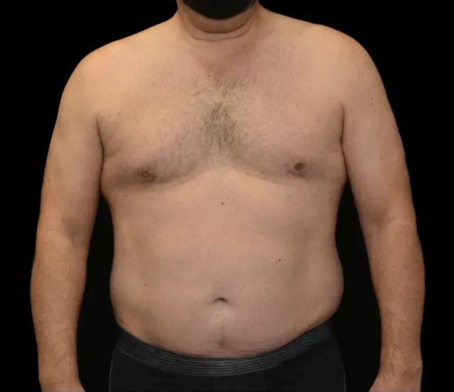 Liposuction before at Dr. Nima Plastic Surgery in Pasadena, CA