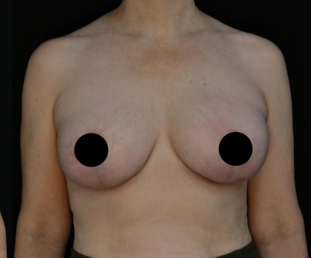 Breast Augmentation after at Dr. Nima Plastic Surgery in Pasadena, CA