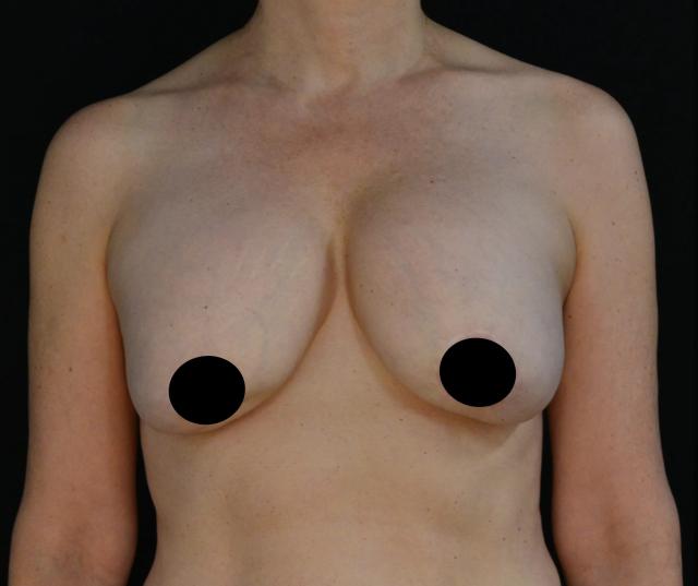 Breast Augmentation before at Dr. Nima Plastic Surgery in Pasadena, CA