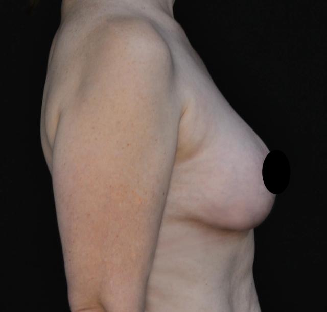 Breast Augmentation after at Dr. Nima Plastic Surgery in Pasadena, CA