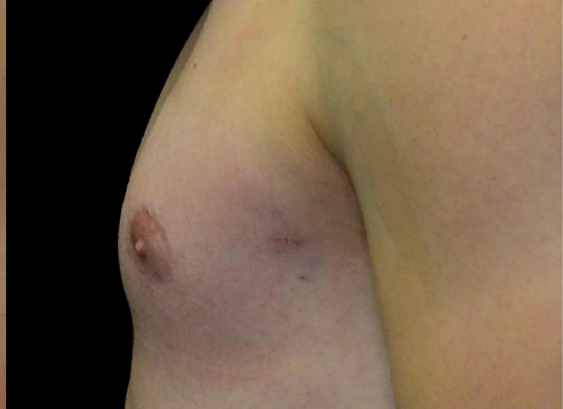 Dr. Nima Plastic Surgery gynecomastia after — Los Angeles, CA