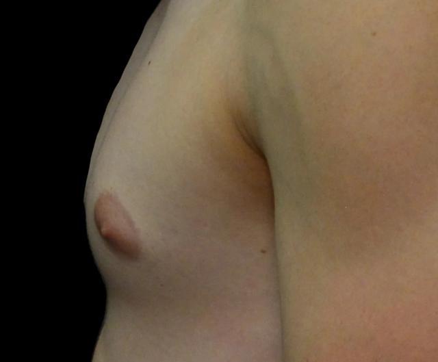 Gynecomastia Surgery before at Dr. Nima Plastic Surgery in Los Angeles, CA