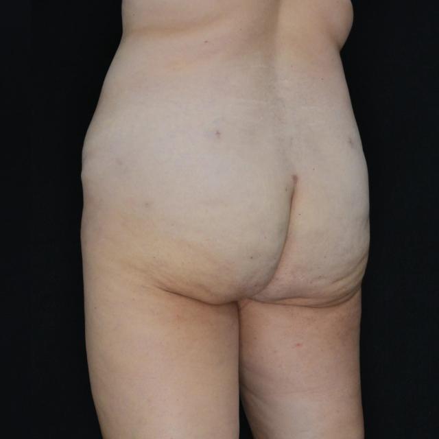 Brazilian Butt Lift after at Dr. Nima Plastic Surgery in Los Angeles, CA