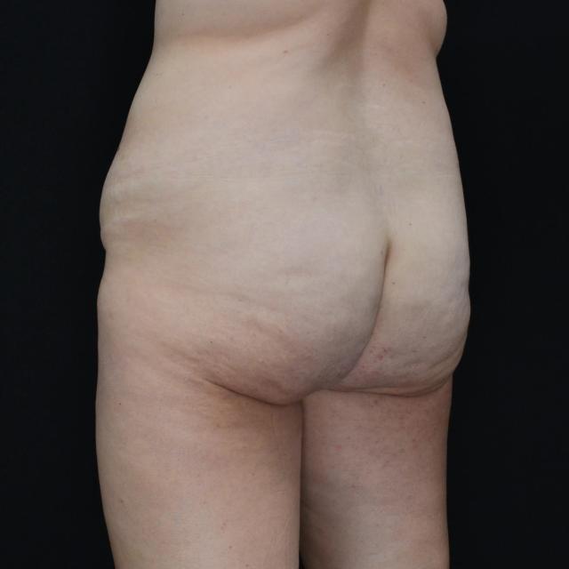 Brazilian Butt Lift before at Dr. Nima Plastic Surgery in Los Angeles, CA