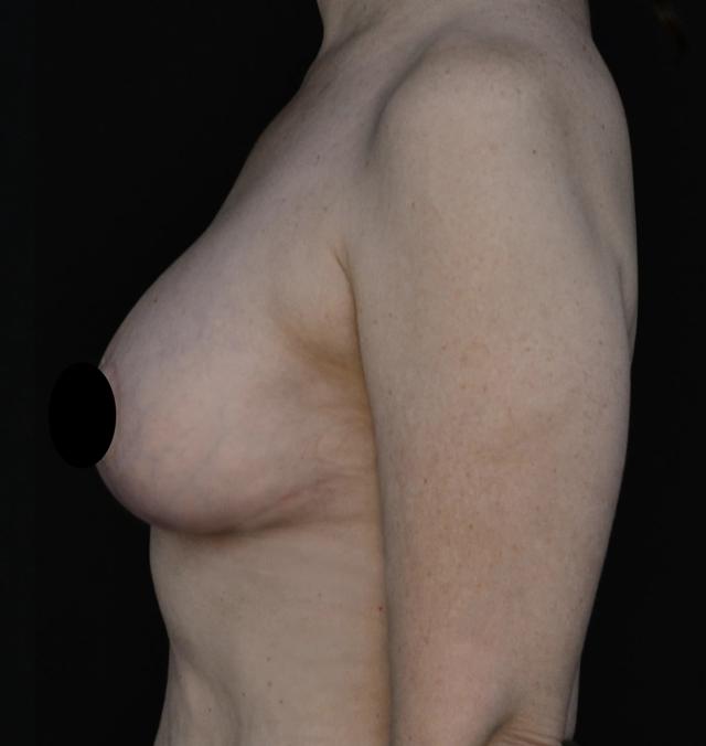 Breast Augmentation after at Dr. Nima Plastic Surgery in Los Angeles, CA