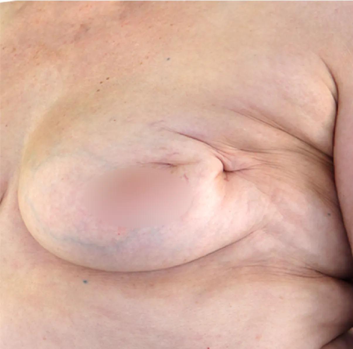 Dr. Nima Plastic Surgery fat transfer after — Los Angeles, CA
