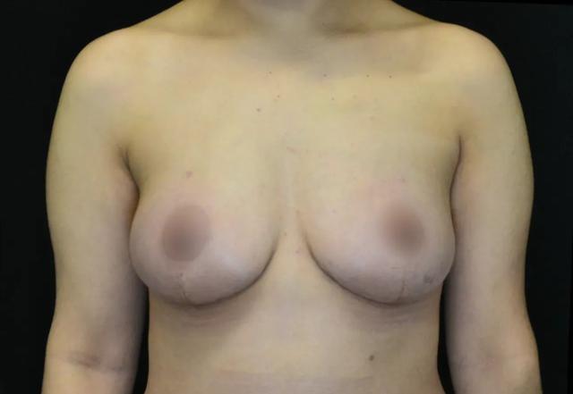 Breast Lift after at Dr. Nima Plastic Surgery in Pasadena, CA