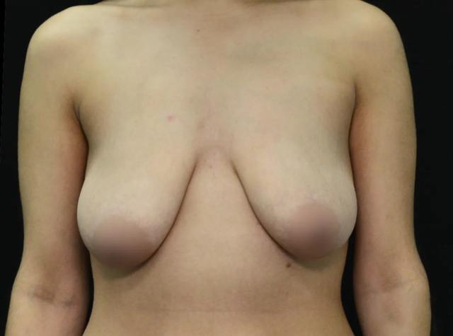 Breast Lift before at Dr. Nima Plastic Surgery in Pasadena, CA