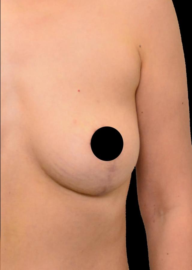 Breast Lift after at Dr. Nima Plastic Surgery in Los Angeles, CA