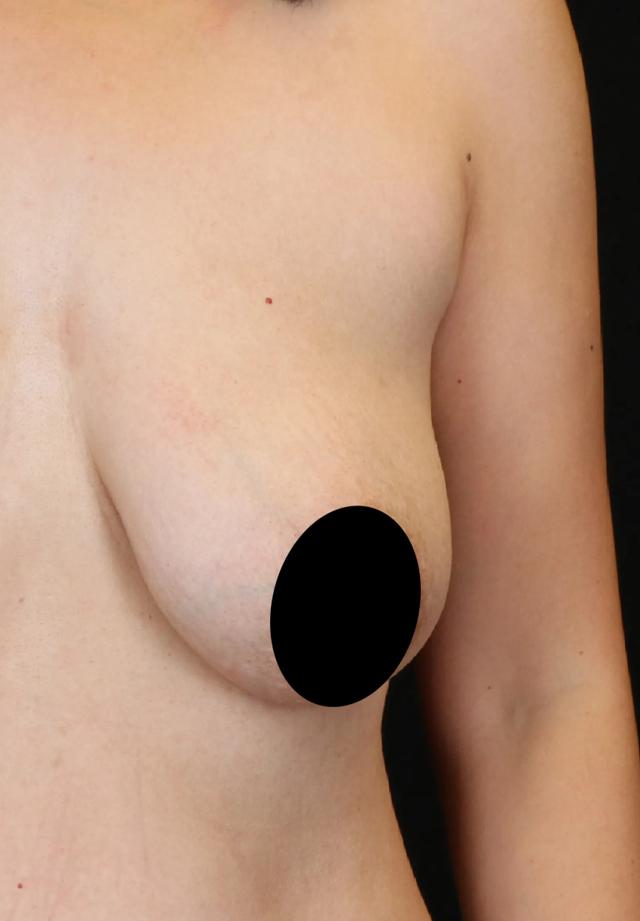 Breast Lift before at Dr. Nima Plastic Surgery in Los Angeles, CA