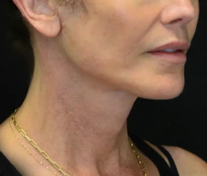 Dr. Nima Plastic Surgery facelift after — Los Angeles, CA