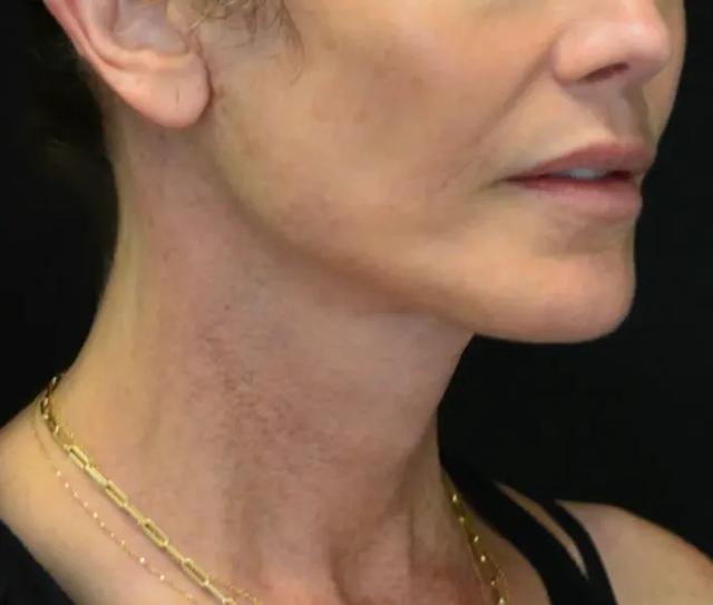 Deep Plane Facelift after at Dr. Nima Plastic Surgery in Pasadena, CA