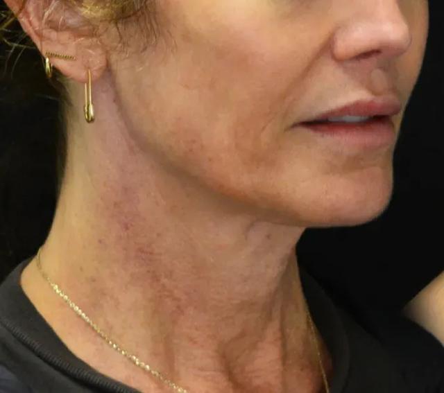 Deep Plane Facelift before at Dr. Nima Plastic Surgery in Pasadena, CA