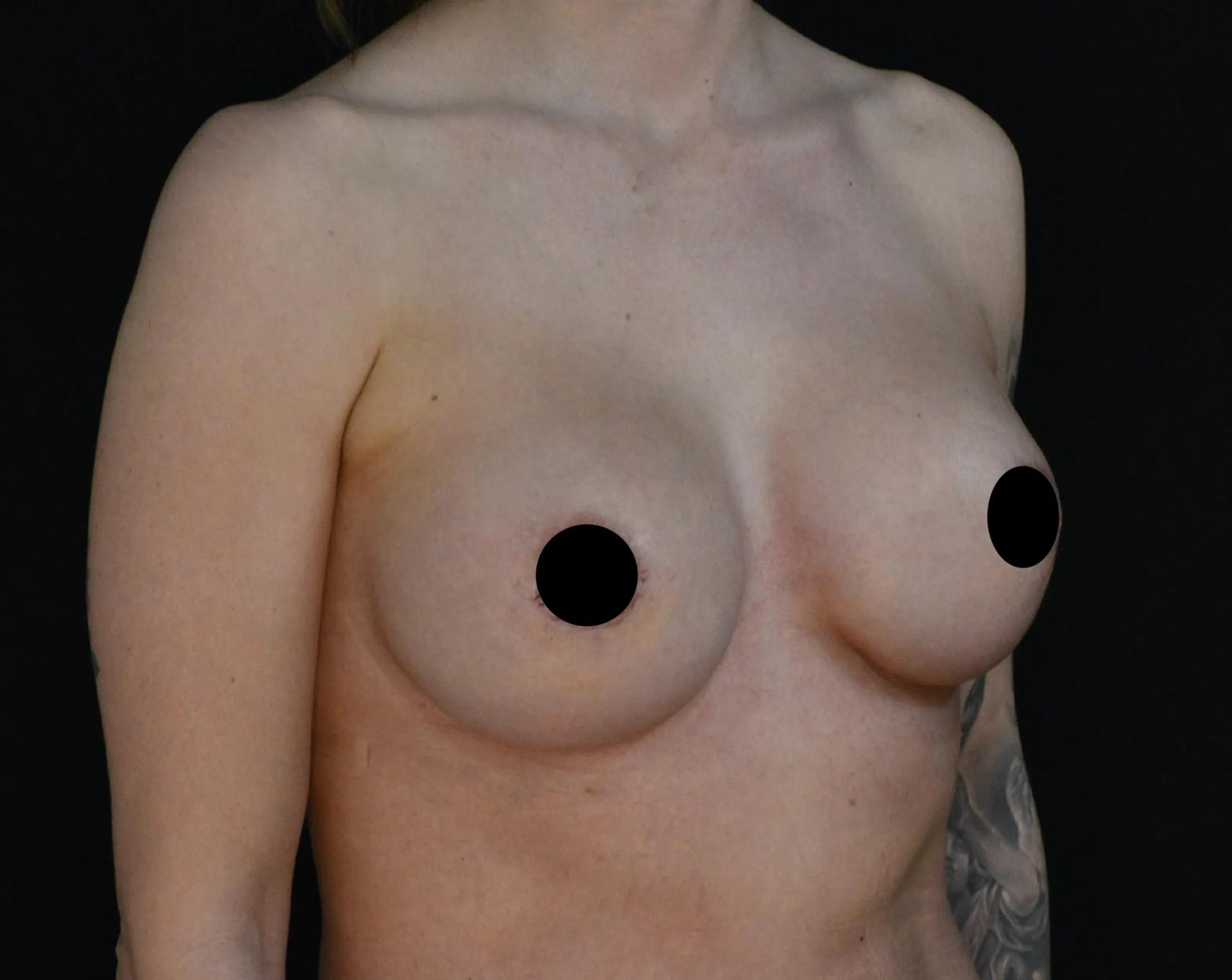 Dr. Nima Plastic Surgery breast augmentation revision after — Pasadena, CA