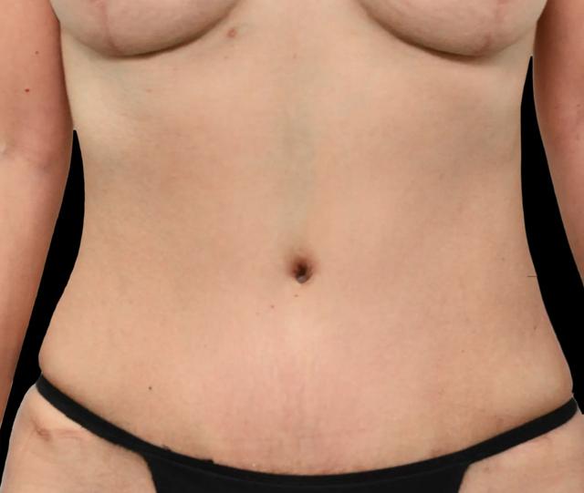 Tummy Tuck after at Dr. Nima Plastic Surgery in Los Angeles, CA