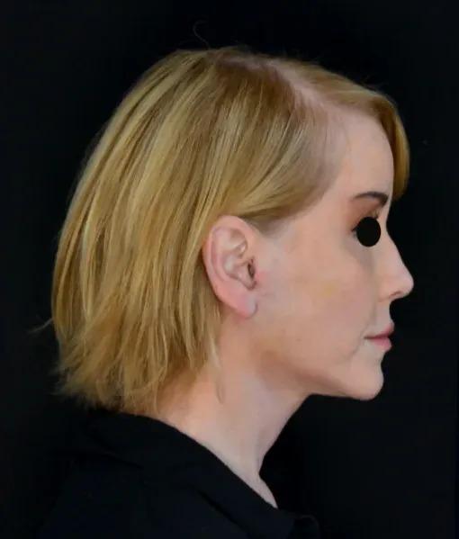 Dr. Nima Plastic Surgery facelift after — Los Angeles, CA