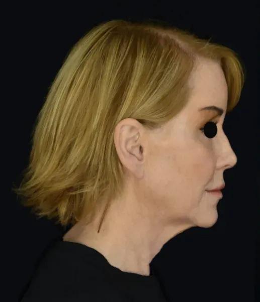 Deep Plane Facelift before at Dr. Nima Plastic Surgery in Pasadena, CA