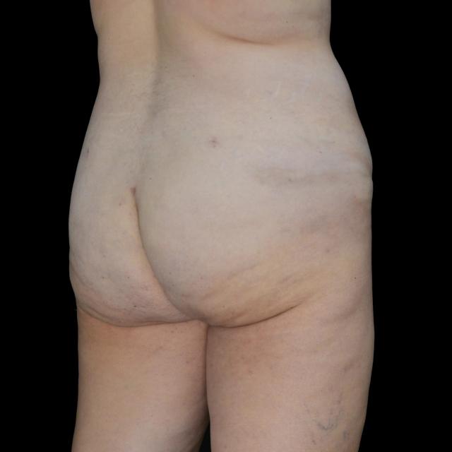 Brazilian Butt Lift after at Dr. Nima Plastic Surgery in Los Angeles, CA