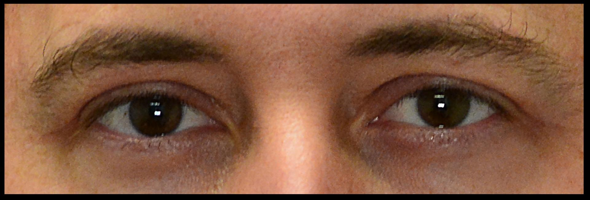 Dr. Nima Plastic Surgery blepharoplasty after — Los Angeles, CA