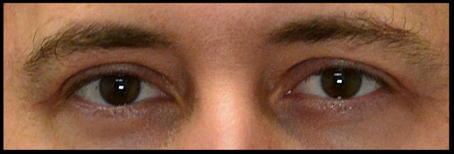 Blepharoplasty after at Dr. Nima Plastic Surgery in Los Angeles, CA