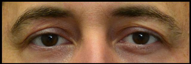 Blepharoplasty before at Dr. Nima Plastic Surgery in Los Angeles, CA
