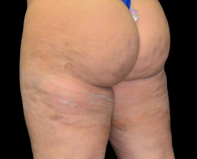 Fat Transfer after at Dr. Nima Plastic Surgery in Los Angeles, CA