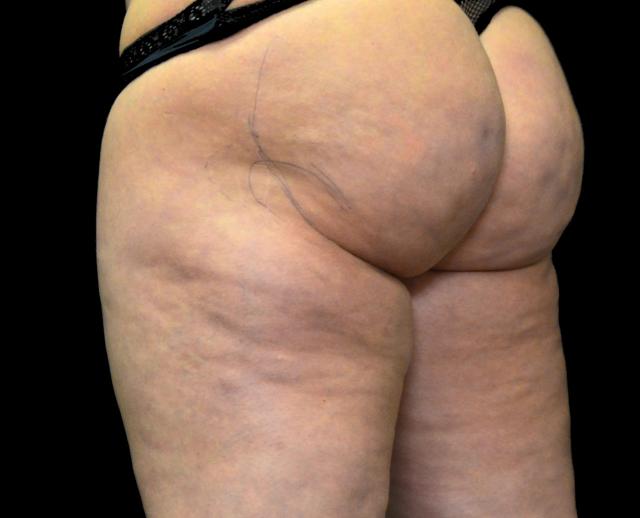 Fat Transfer before at Dr. Nima Plastic Surgery in Los Angeles, CA