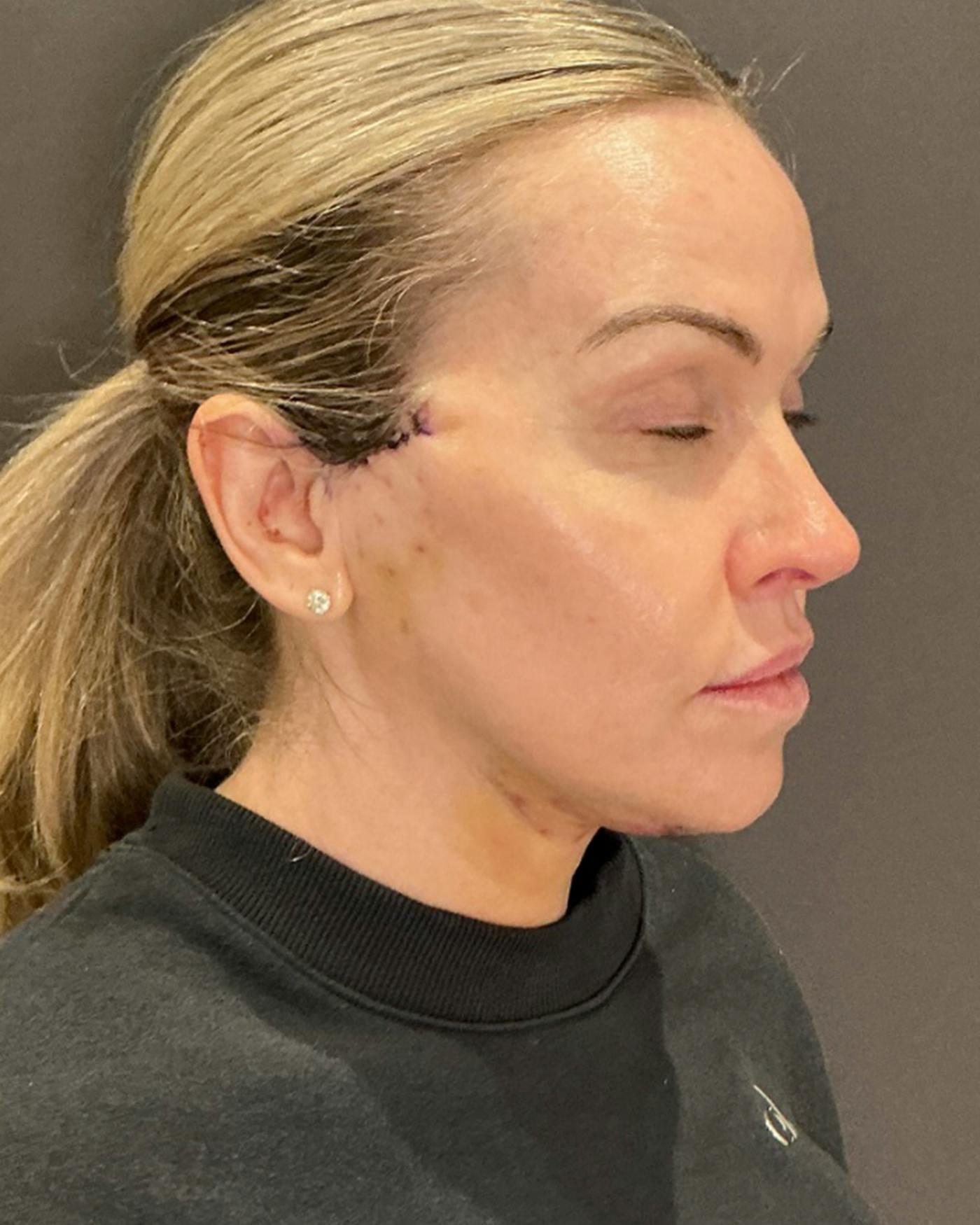 Mark G. Albert, MD, FACS facelift after — New York, NY